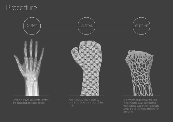 Cast For a Broke Bone: What Is It Made Of?